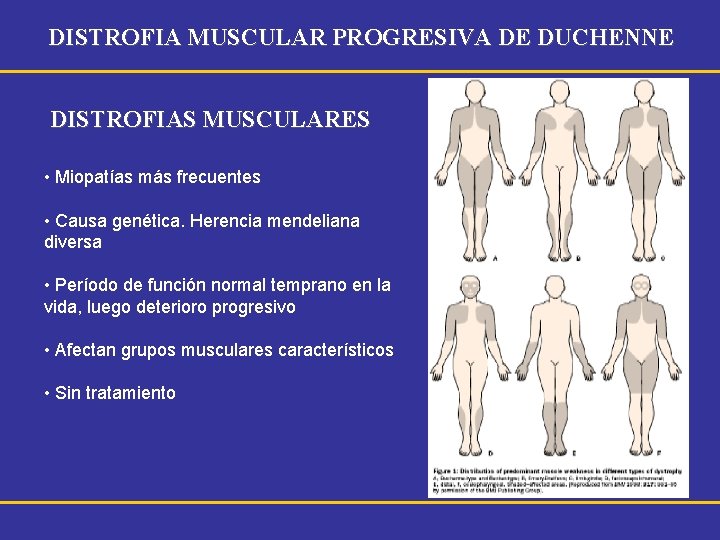 DISTROFIA MUSCULAR PROGRESIVA DE DUCHENNE DISTROFIAS MUSCULARES • Miopatías más frecuentes • Causa genética.
