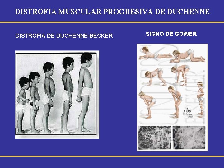 DISTROFIA MUSCULAR PROGRESIVA DE DUCHENNE DISTROFIA DE DUCHENNE-BECKER SIGNO DE GOWER 