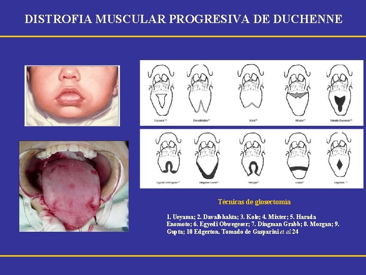 DISTROFIA MUSCULAR PROGRESIVA DE DUCHENNE Técnicas de glosectomía 1. Ueyama; 2. Davalbhakta; 3. Kole;