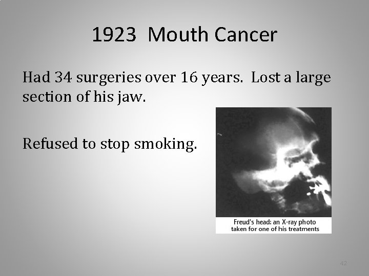 1923 Mouth Cancer Had 34 surgeries over 16 years. Lost a large section of 1923 Mouth Cancer Had 34 surgeries over 16 years. Lost a large section of