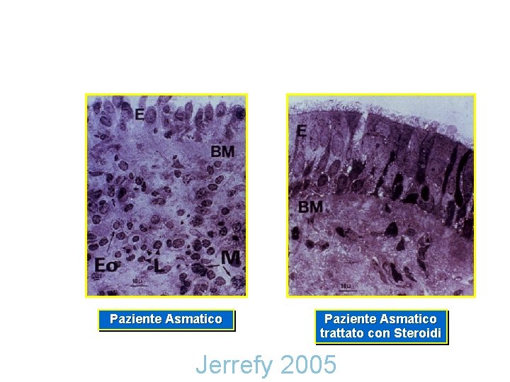 Paziente Asmatico trattato con Steroidi Jerrefy 2005 