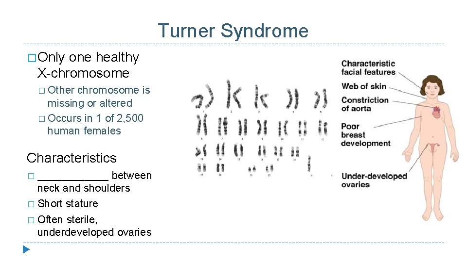 Turner Syndrome �Only one healthy X-chromosome � Other chromosome is missing or altered �