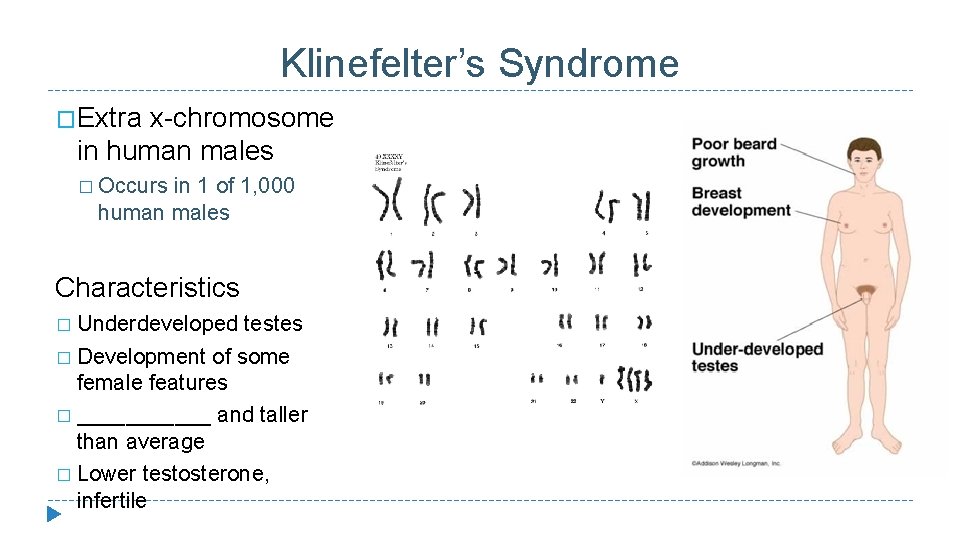 Klinefelter’s Syndrome �Extra x-chromosome in human males � Occurs in 1 of 1, 000