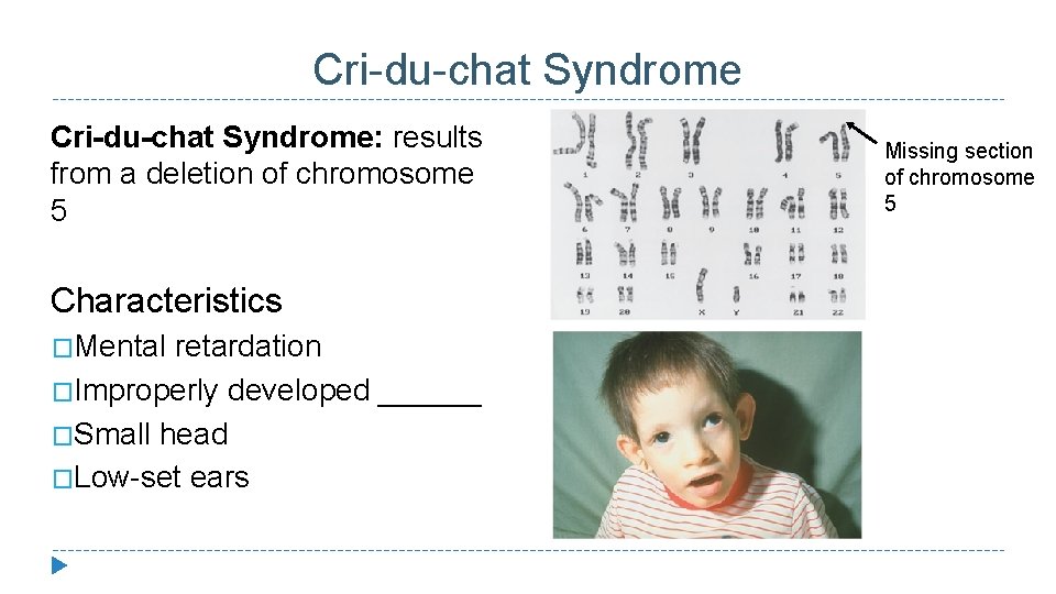 Cri-du-chat Syndrome: results from a deletion of chromosome 5 Characteristics �Mental retardation �Improperly developed