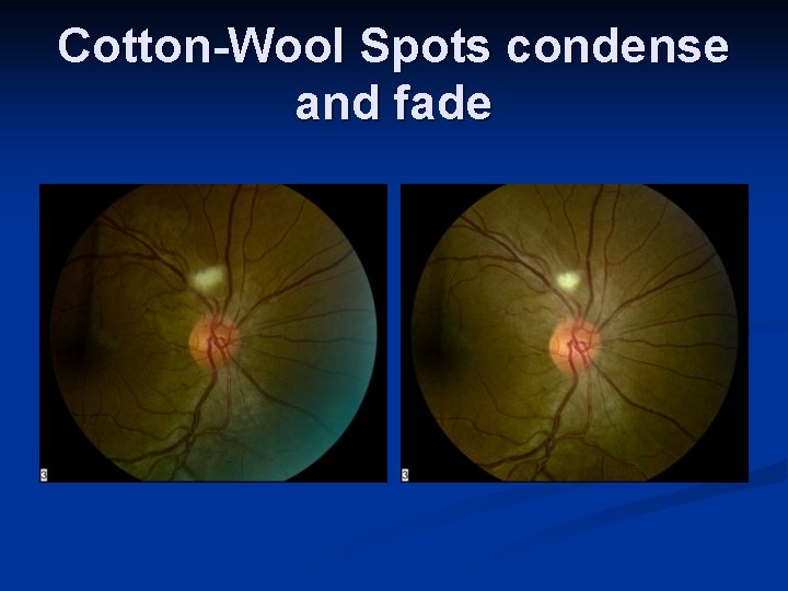 Cotton-Wool Spots condense and fade 