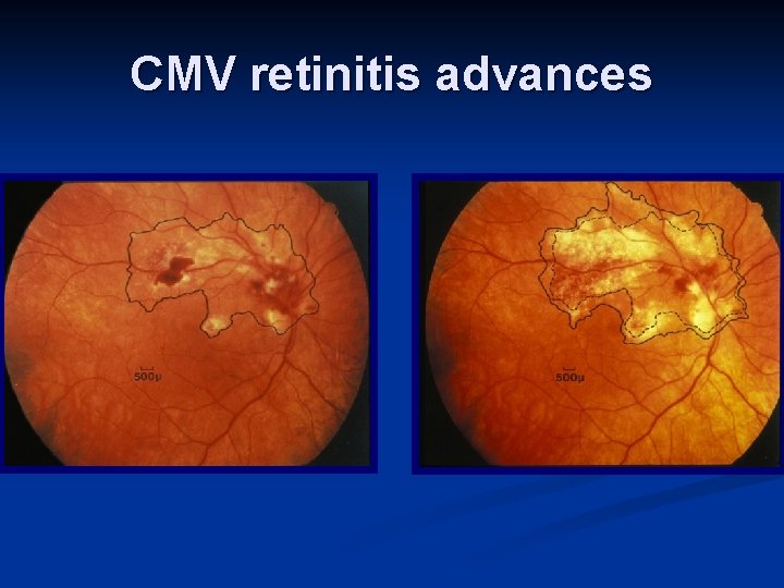 CMV retinitis advances 