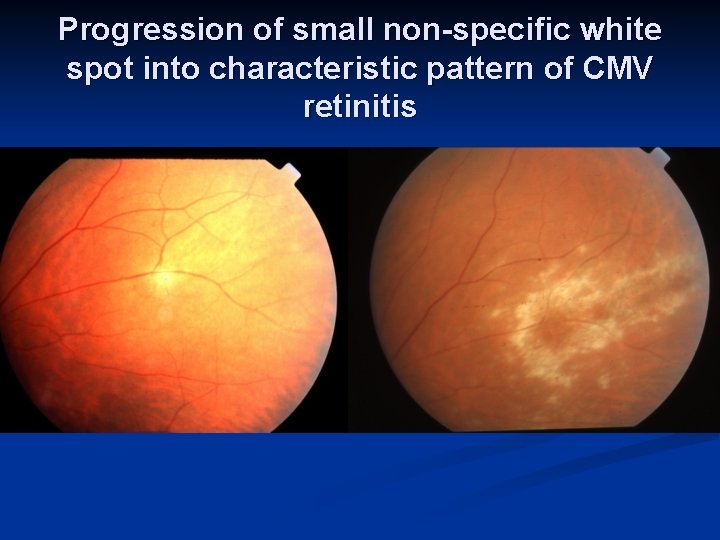 Progression of small non-specific white spot into characteristic pattern of CMV retinitis 