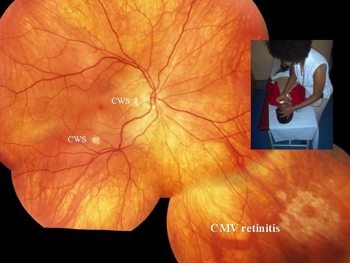 CWS CMV retinitis 