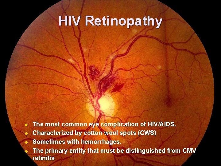 HIV Retinopathy u u The most common eye complication of HIV/AIDS. Characterized by cotton