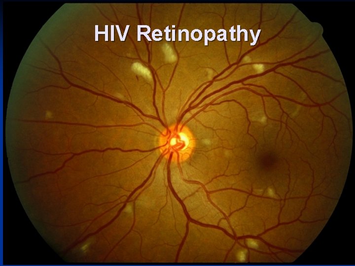 HIV Retinopathy 