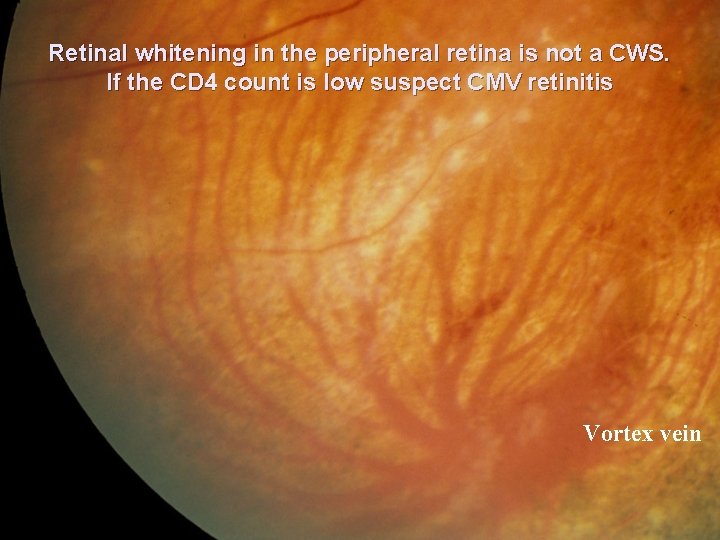 Retinal whitening in the peripheral retina is not a CWS. If the CD 4