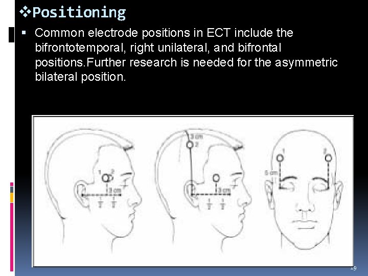 v. Positioning Common electrode positions in ECT include the bifrontotemporal, right unilateral, and bifrontal v. Positioning Common electrode positions in ECT include the bifrontotemporal, right unilateral, and bifrontal