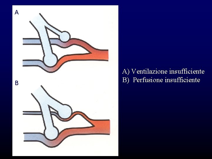 A B A) Ventilazione insufficiente B) Perfusione insufficiente A B A) Ventilazione insufficiente B) Perfusione insufficiente
