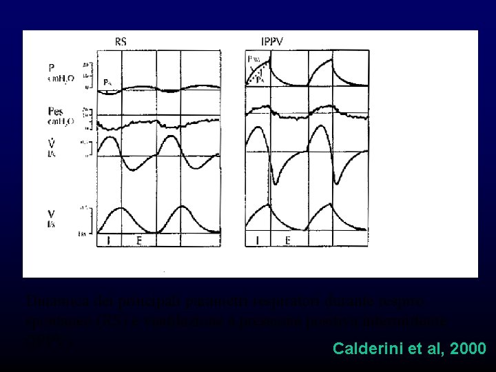 Dinamica dei principali parametri respiratori durante respiro spontaneo (RS) e ventilazione a pressione positiva Dinamica dei principali parametri respiratori durante respiro spontaneo (RS) e ventilazione a pressione positiva