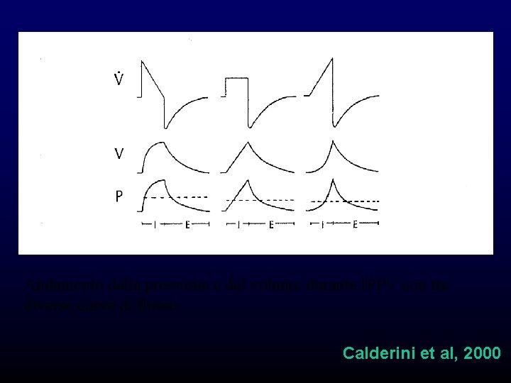 Andamento della pressione e del volume durante IPPV con tre diverse curve di flusso. Andamento della pressione e del volume durante IPPV con tre diverse curve di flusso.