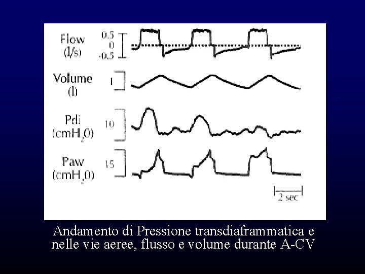 Andamento di Pressione transdiaframmatica e nelle vie aeree, flusso e volume durante A-CV Andamento di Pressione transdiaframmatica e nelle vie aeree, flusso e volume durante A-CV