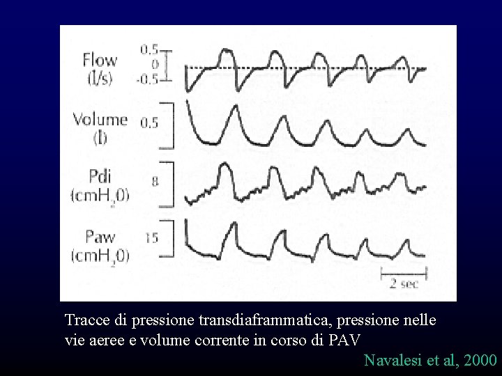 Tracce di pressione transdiaframmatica, pressione nelle vie aeree e volume corrente in corso di Tracce di pressione transdiaframmatica, pressione nelle vie aeree e volume corrente in corso di