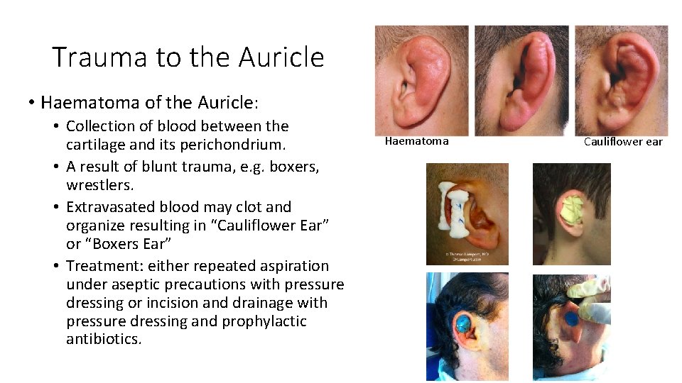 Trauma to the Auricle • Haematoma of the Auricle: • Collection of blood between