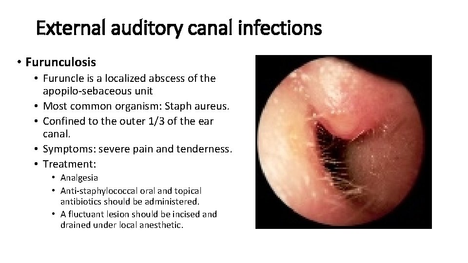 External auditory canal infections • Furunculosis • Furuncle is a localized abscess of the