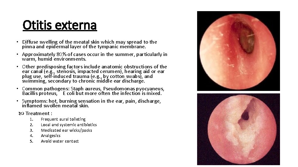 Otitis externa • Diffuse swelling of the meatal skin which may spread to the