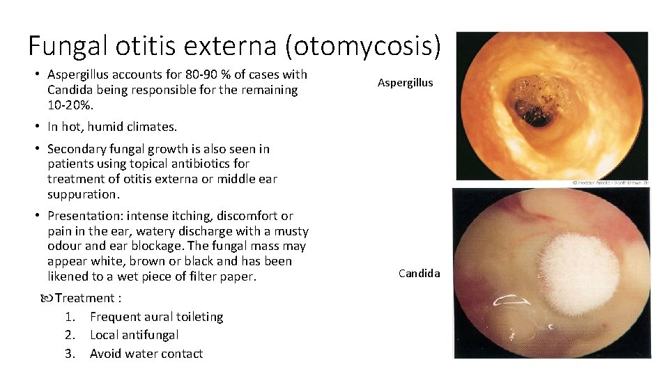 Fungal otitis externa (otomycosis) • Aspergillus accounts for 80 -90 % of cases with