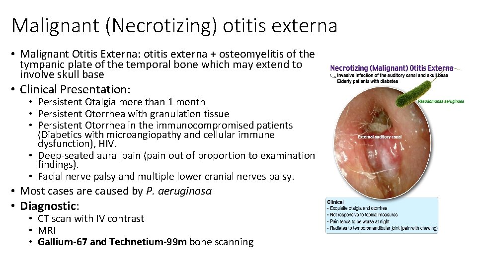 Malignant (Necrotizing) otitis externa • Malignant Otitis Externa: otitis externa + osteomyelitis of the