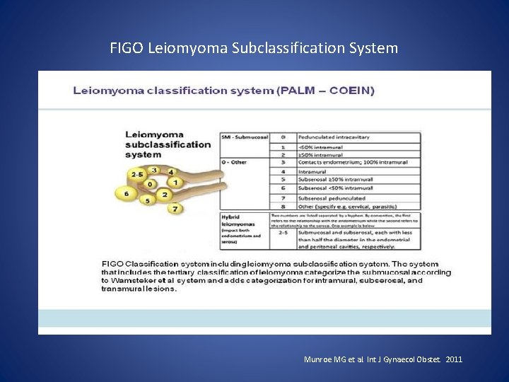 FIGO Leiomyoma Subclassification System Munroe MG et al. Int J Gynaecol Obstet. 2011 