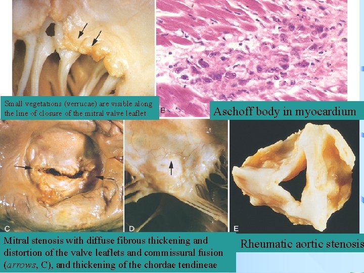Small vegetations (verrucae) are visible along the line of closure of the mitral valve