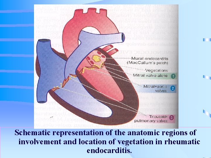 . Schematic representation of the anatomic regions of involvement and location of vegetation in
