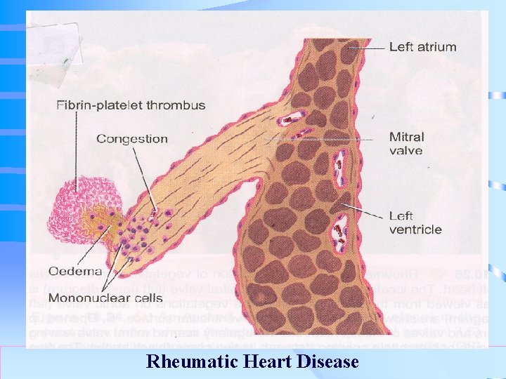 . Rheumatic Heart Disease 