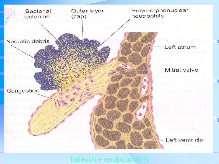 . Infective endocarditis 