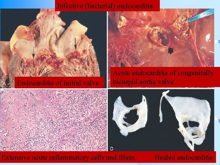 Infective (bacterial) endocarditis. Endocarditis of mitral valve Acute endocarditis of congenitally bicuspid aortic valve