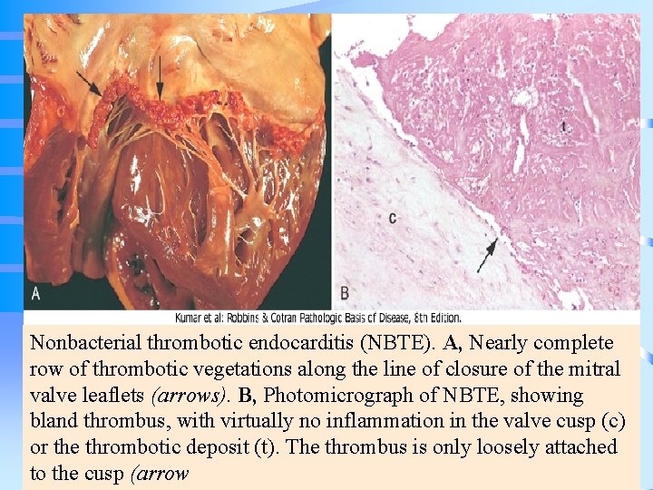 Nonbacterial thrombotic endocarditis (NBTE). A, Nearly complete row of thrombotic vegetations along the line