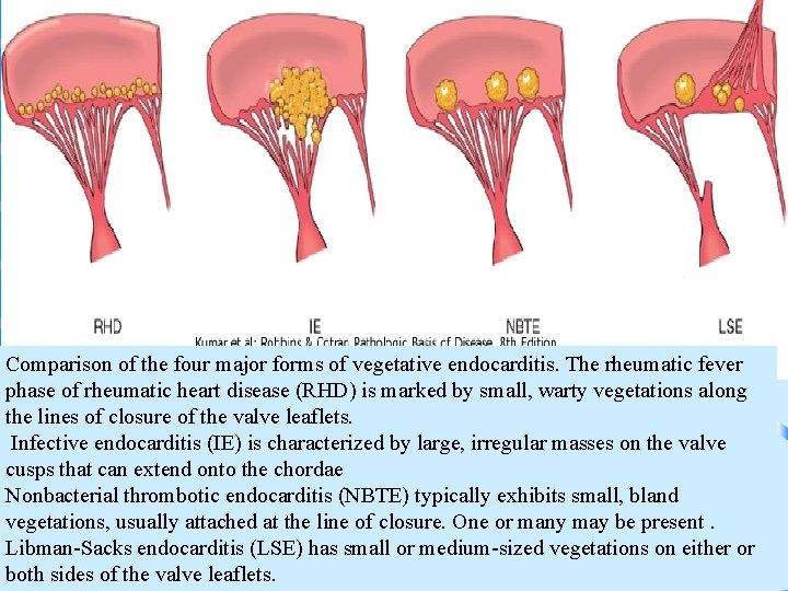 Comparison of the four major forms of vegetative endocarditis. The rheumatic fever phase of