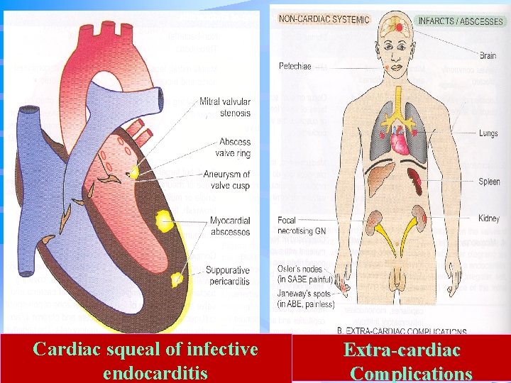 . Cardiac squeal of infective endocarditis Extra-cardiac Complications 