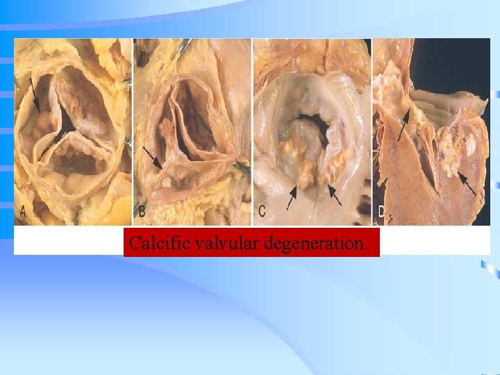 Calcific valvular degeneration. 