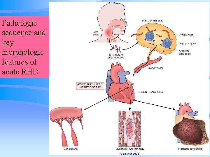 Pathologic sequence and key morphologic features of acute RHD 