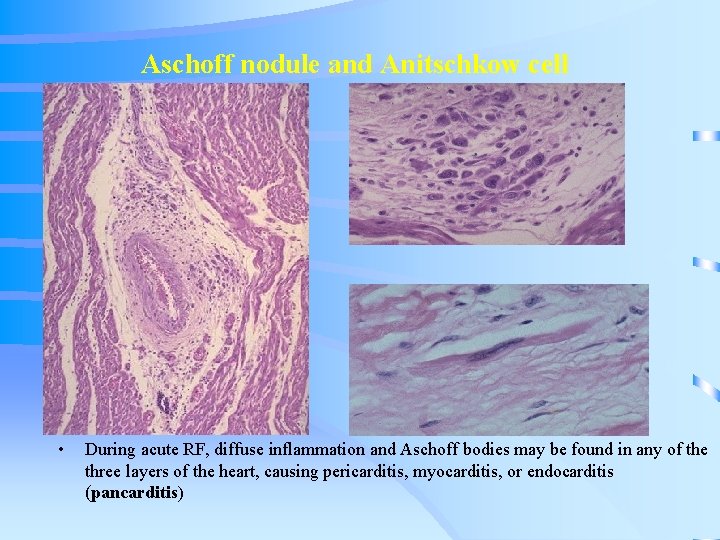 Aschoff nodule and Anitschkow cell • During acute RF, diffuse inflammation and Aschoff bodies