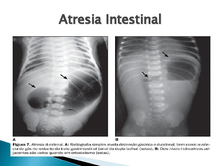 Atresia Intestinal 
