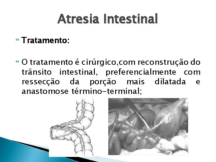 Atresia Intestinal Tratamento: O tratamento é cirúrgico, com reconstrução do trânsito intestinal, preferencialmente com