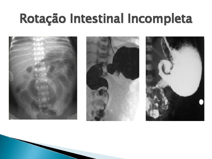 Rotação Intestinal Incompleta 