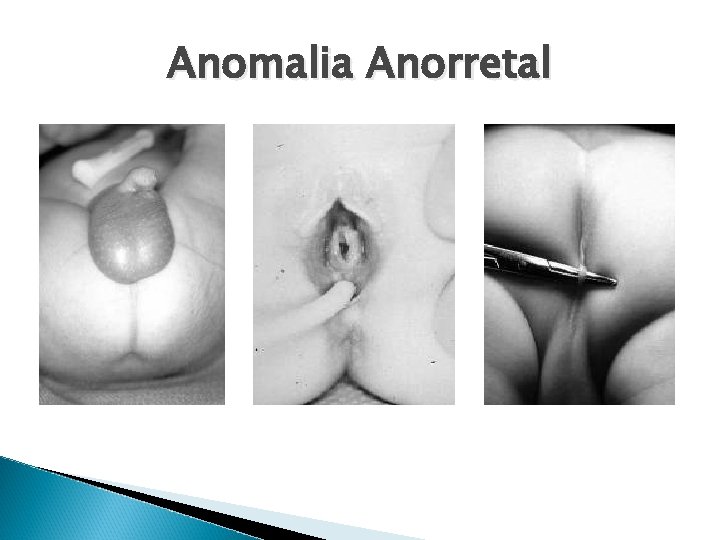 Anomalia Anorretal 