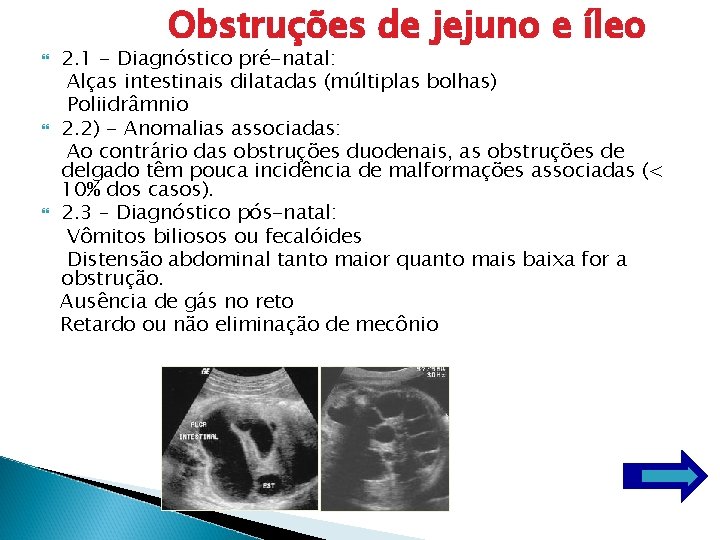  Obstruções de jejuno e íleo 2. 1 - Diagnóstico pré-natal: Alças intestinais dilatadas