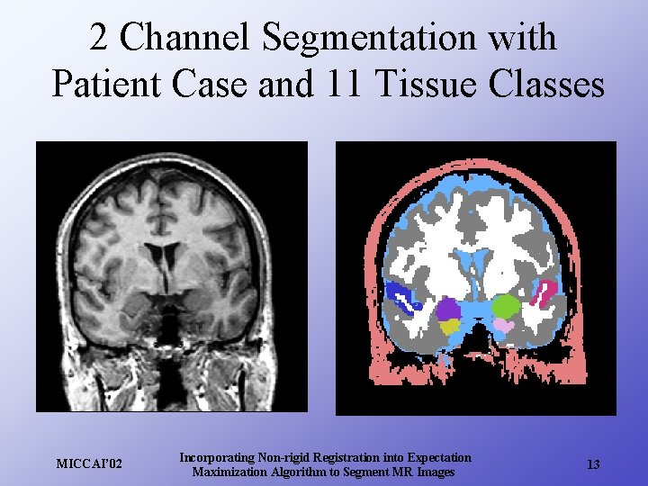 2 Channel Segmentation with Patient Case and 11 Tissue Classes MICCAI’ 02 Incorporating Non-rigid