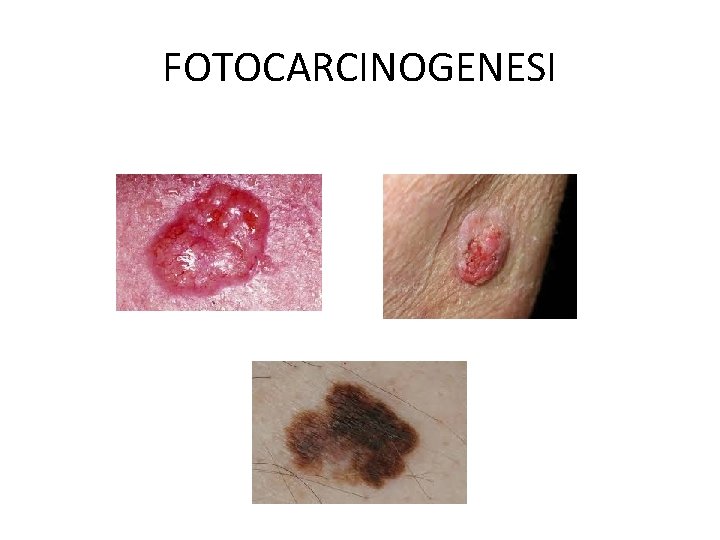 FOTOCARCINOGENESI 