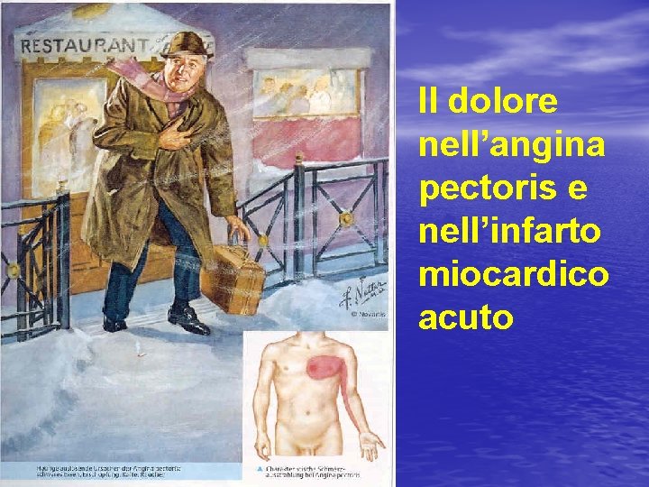 Il dolore nell’angina pectoris e nell’infarto miocardico acuto 