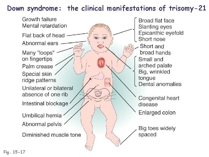 Down syndrome: the clinical manifestations of trisomy-21 Fig. 15 -17 