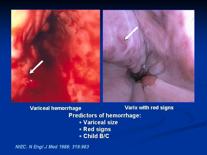 PROGNOSTIC INDICATORS OF FIRST VARICEAL HEMORRHAGE Variceal hemorrhage Varix with red signs Predictors of