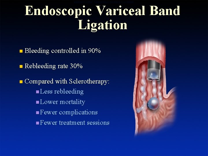 ENDOSCOPIC VARICEAL BAND LIGATION Endoscopic Variceal Band Ligation n Bleeding controlled in 90% n