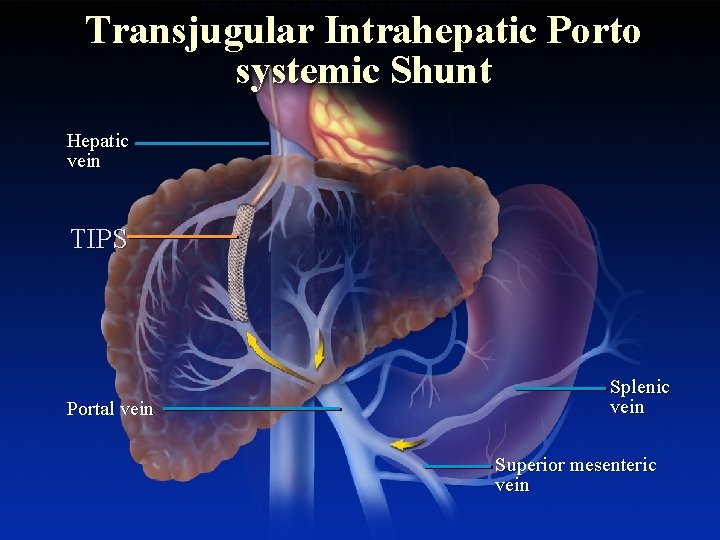 THE TRANSJUGULAR INTRAHEPATIC PORTOSYSTEMIC SHUNT Transjugular Intrahepatic Porto systemic Shunt Hepatic vein TIPS Portal